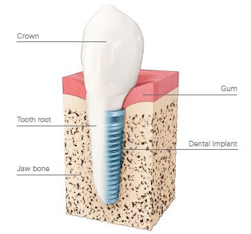 implant.jpg